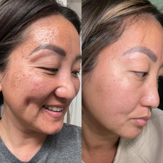 "28 weeks using all 4 products. Bar soap - cure - serum 2 & cream" -Susan